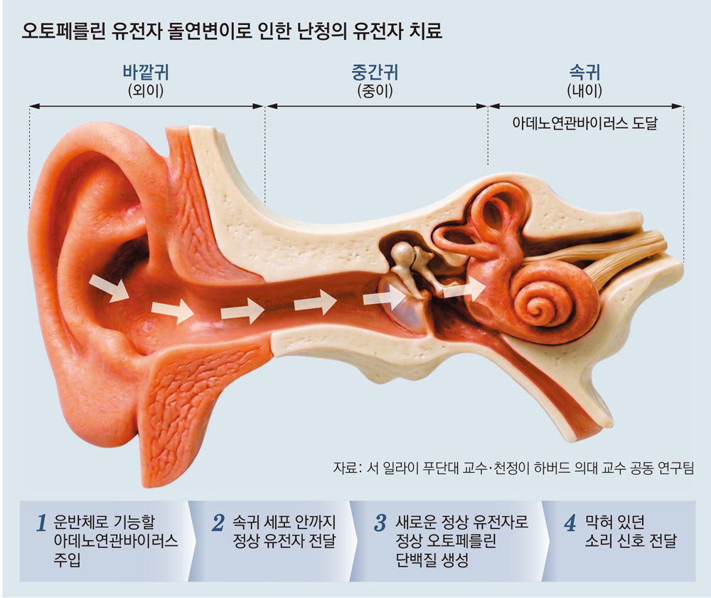 ‘정상 유전자’를 난청 환자 귀에 주입… “소리가 들려요”