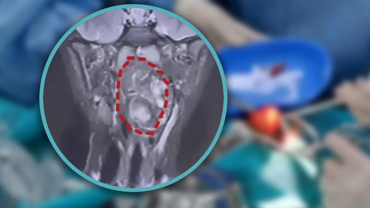 China boy, 6, discovers lump in throat that was initially thought to be ‘undeveloped twin’